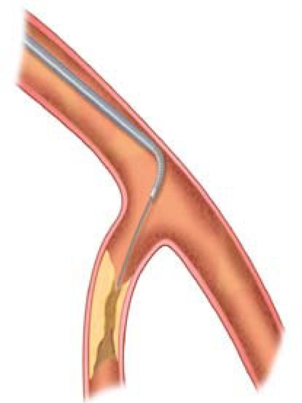 The VentureTM wire control catheter The British Journal of Cardiology