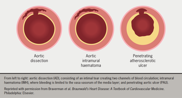 Acute Aortic Dissection Aad A Lethal Disease The Epidemiology