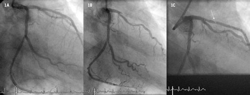 Br-J-Cardiol-2008-15-21-figure-1