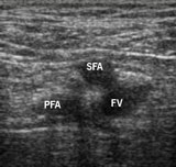 Figure 3. Cross-sectional images of the right femoral vessels approximately 3 cm below the inguinal ligament, orientated to be as seen from patient’s feet. The superficial femoral artery (SFA) partially overlaps the femoral vein (FV). The profunda femoris artery (PFA) is deeper