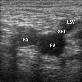 Figure 4. Cross-sectional images of the right common femoral vessels just below the inguinal ligament, showing the ‘Mickey Mouse sign’. The femoral artery (FA) is depicted on the left and the femoral vein (FV) on the right. The sapheno-femoral junction (SFJ) comprises the long saphenous vein (LSV) and the FV