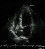 Figure 1. Transthoracic echocardiogram: apical four-chamber view