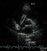 Figure 2. Transthoracic echocardiogram: parasternal short axis view (aortic valve level) 