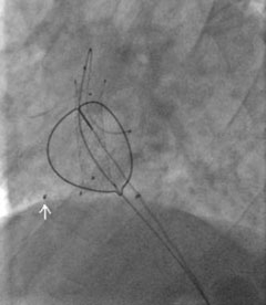 Figure 4. Screening: left anterior oblique – caudal view