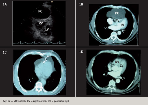 Figure 1. A. Echocardiogram demonstrating large pericardial cyst. B. Computed tomography (CT) scan of chest. C. CT guided drainage of pericardial cyst. D. Follow-up CT scan of chest