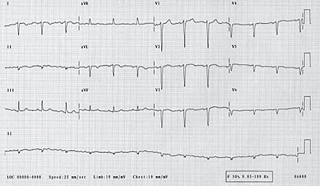 Percutaneous Coronary Intervention In Dextrocardia The British Journal Of Cardiology