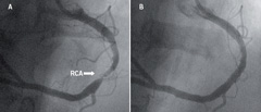 Figure 2. Percutaneous revascularisation of the morphologic right coronary artery (RCA)