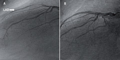 Figure 3. Percutaneous revascularisation of a morphologic left anterior descending (LAD) artery