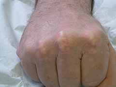 Figure 1. Xanthomata of the knuckles 