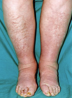 Figure 2. Non-pitting oedema of lower limbs consistent with myxoedema