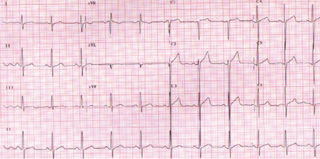 Figure 1. Electrocardiogram (ECG) features of left ventricular hypertrophy