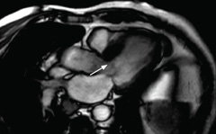 Figure 2. Marked asymmetric septal hypertrophy (max 23 mm) associated with systolic anterior motion of the mitral valve plus left ventricular outflow tract obstruction at rest