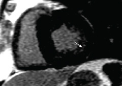 Figure 3. Evidence of patchy mid-wall fibrosis