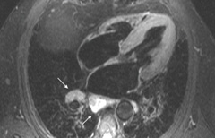 Figure 4. Extensive lymphadenopathy and lung changes strongly suggestive of underlying pulmonary sarcoidosis