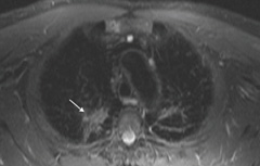 Figure 5. Lung apices showing parenchymal changes