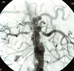 Figure 1. A flush aortogram showing tight right-sided renal artery stenosis and a diffusely atherosclerotic aorta