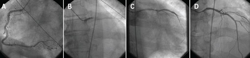 Figure 2. Coronary angiography confirming a normal right coronary artery (A), and an occlusion of the left main coronary artery (B). This was pre-dilated (C), and then started with a bare metal stent (3.5 x 16mm Liberté) producing an excellent angiographic result (D)