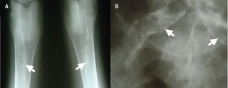 Figure 1. Plain X-rays of calcified vessels: (A) calcified peripheral vessels; (B) calcified iliac vessels