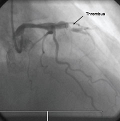 Figure 1. Right anterior oblique view of the left coronary artery with evidence of a filling defect (thrombus, arrow) and minimal flow in the left anterior descending artery