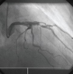 Br-J-Cardiol-2008-15-326-328-figure-2