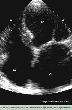 Figure 1. Echocardiogram in a patient with chronic atrial fibrillation, where the left atrium is significantly enlarged