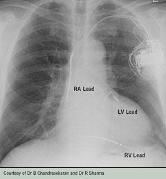 Figure 2. Selected patients at high risk of sudden cardiac death may be suitable to have an implantable cardioverter defibrillator (ICD)