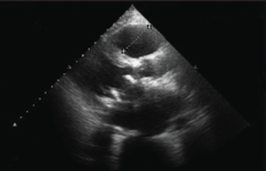 Figure 1. Echocardiogram showing dilated left atrium