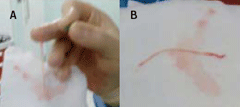 Figure 1. A shows an elongated cylindrical piece of tissue shown upon aspirating the sheath; B shows that on histopathology, this tissue was confirmed as arterial endothelium