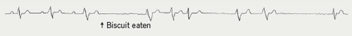 Figure 1. ECG recording from a 60 year old man who experienced palpitations after eating. He developed atrial fibrillation after eating a biscuit. He was found to have reflux oesophagitis and no cardiac abnormality. Treatment with the proton pump inhibitor omeprazole solved the problem. 