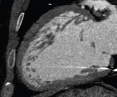 Figure 1. Computed tomography (CT) sagittal reconstruction, two-chamber view. The subepicardial myocardium is thin and normally compacted with a thicker non-compacted subendocardial layer in the anterior wall and apex. Note the artefact from the right ventricular (RV) pacemaker tip