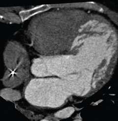 Figure 2. CT five-chamber view again showing prominent trabeculations along the lateral and anteroapical wall of the left ventricle