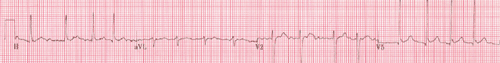 Figure 1. Electrocardiogram (ECG) showing new-onset atrial fibrillation