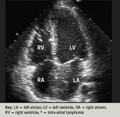 Figure 2. Echocardiography showing large intra-atrial mass