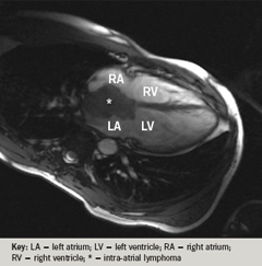 Figure 3. Cardiac magnetic resonance image (MRI) consistent with a lymphoma tumour