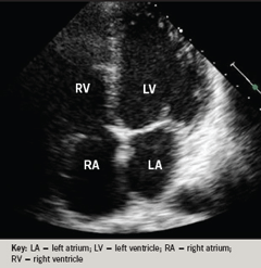 Figure 4. Echocardiograph demonstrating full resolution of the intra-atrial mass