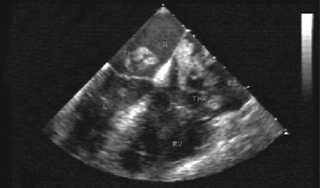 Figure 1. Trans-oesophageal echocardiograph showing a large multi-lobed echogenic mass attached to interatrial septum and protruding into all four cardiac chambers via patent foramen ovale