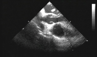 Figure 2. Trans-oesophageal echocardiograph image showing the long vermicular thrombus protruding through the left ventricular outflow tract and crossing the aortic valve in systole