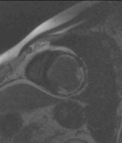 Figure 1. A short-axis slice of the mid left ventricle illustrating contrast enhancement in the anterior segment (25% transmurality – viable), anterolateral segment (50–75% transmurality – non-viable), inferolateral segment (50% transmurality – potentially viable)