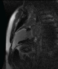 Figure 2. A long-axis slice demonstrating contrast enhancement in the anterior wall in the basal segment (50% transmurality – potentially viable), mid and apical segments and apical cap (>75% transmurality – nonviable