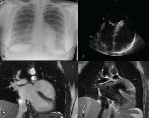 Figure 1. A: Chest radiograph exhibiting abnormal left heart border; B: Transoesophageal echocardiograph; C and D: Magnetic resonance imaging of the thorax confirming a large aneurysm arising from the left atrial appendage