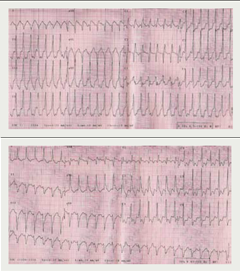 Figure 1. 12-lead electrocardiogram (ECG) demonstrates ventricular tachycardia of varying morphology