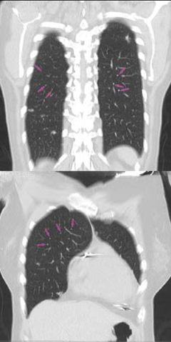  Figure 2. High-resolution computed tomography demonstrating several ill-defined nodules in all zones of the lungs consistent with pulmonary sarcoid