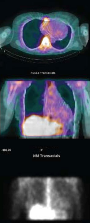 Figure 3. Nuclear medicine image showing normal uptake of gallium in liver, bones and abnormally increased uptake in the region of heart