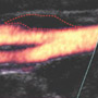 Screening for cardiovascular risk