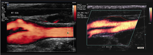 Figure 1. Ultrasound arterial scans showing a normal carotid bifurcation with blood flow shown in red (left) and a bifurcation with a plaque outlined by a red dotted line (right) 