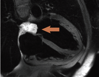 Figure 1. T2 weighted spin echo sequence (CMR) showing high signal intensity of left atrial mass