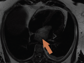 Figure 2. Cardiac magnetic resonance (CMR) four-chamber view showing large left atrial mass prolapsing into left ventricle