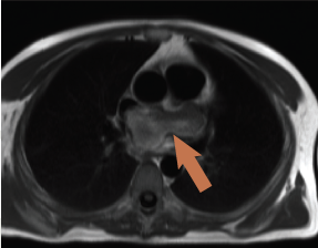 Figure 3. ‘Black blood’ image showing left atrial mass with extracardiac extension