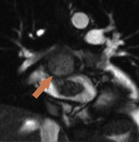 Figure 4. Coronal ‘white blood’ slice showing breach of the left atrial roof