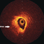 From patient to plaque. Contemporary coronary imaging – part 2: optical coherence tomography 